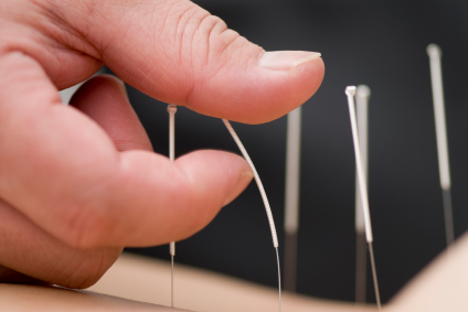 Akupunktur – 针刺